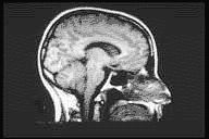 MRI scan of a human head